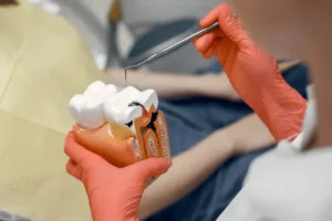 Tooth Fillings for cavities