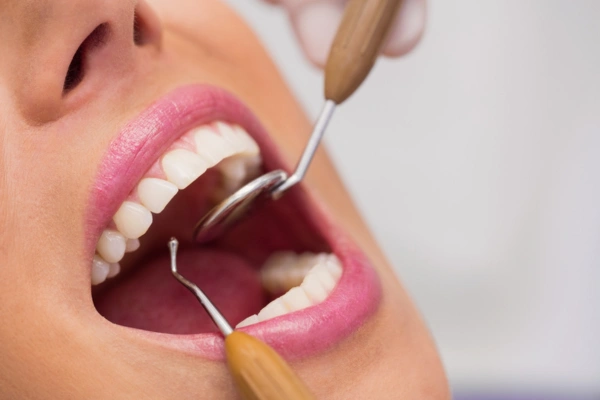 Teeth Whitening