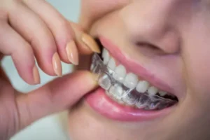 Braces & Aligners for alignment correction